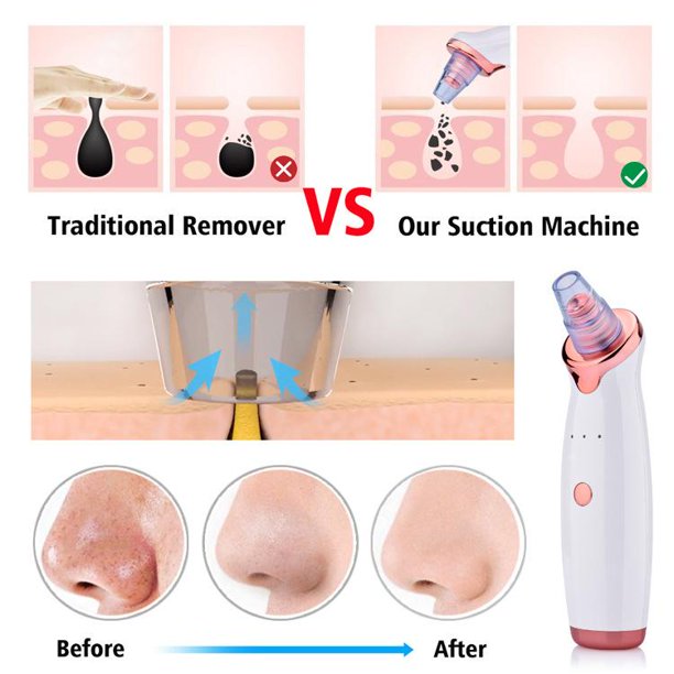 N1 Electric Blackhead Remover Pore Vacuum Suction Dermabrasion Face Cleaner